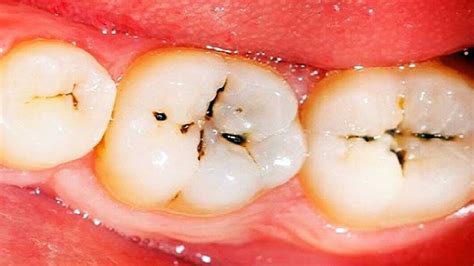 Tooth Cavity: Symptoms, Causes & Treatment