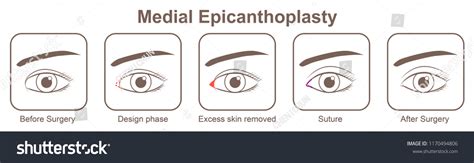 Best Epicanthoplasty Eyes Royalty-Free Images, Stock Photos & Pictures | Shutterstock