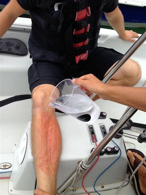 First Aid Afloat - jellyfish stings - Safe Skipper Boating & Safety Afloat Apps for phones & tablets