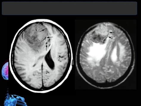 Imaging of Intracranial Meningioma