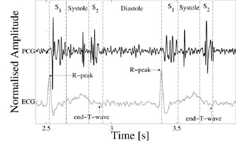 Classification of normal and abnormal heart sounds | Semantic Scholar