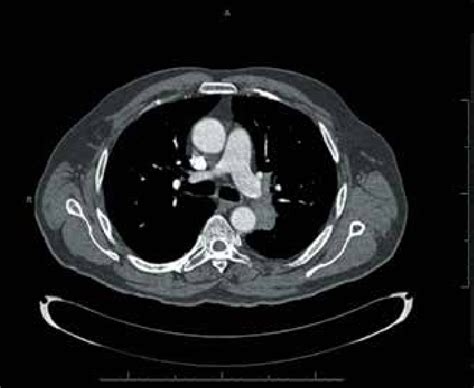 A CT scan showing a heterogeneously enhancing soft-tissue mass in the ...