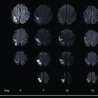 Consecutive diffusion-weighted imaging during the second stroke-like... | Download Scientific ...