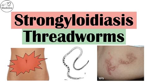 Strongyloidiasis (Threadworms) | Causes, Pathophysiology, Signs and Symptoms, Diagnosis, Treatment