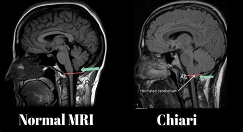 MRI Arnold Chiari malformation type ll - MEDizzy