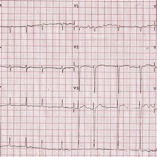 The ECG for case 1 shows an irregular rhythm with absent p wave and t... | Download Scientific ...