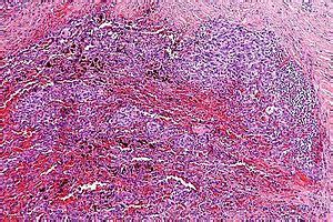 Histiocytoma Histology