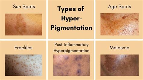 Hyperpigmentation: Types and Treatments | Essential Life Skin Products