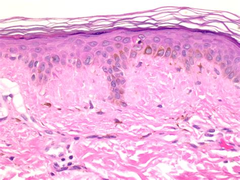 Lichen amyloidosis = الحزاز النشواني