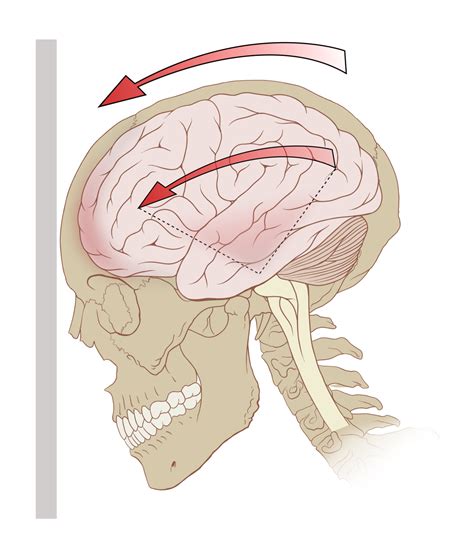 Post Concussion Syndrome: Michgian Brain Injury Lawyers