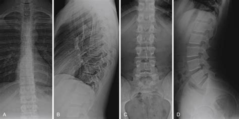 The Thoracolumbar Spine | Radiology Key