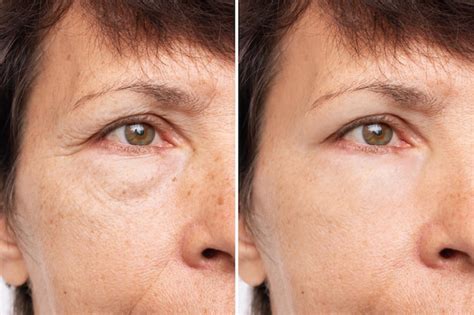 Premium Photo | Two shots of an elderly woman face with puffiness under ...