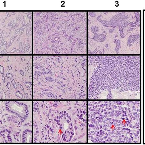 Invasive Ductal Carcinoma Histology