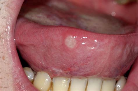 Aphthous Ulcer On The Tongue Photograph by Dr P. Marazzi/science Photo Library