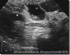 "Ultrasound Pictures Renal Vein Thrombosis" ~ Ultrasound Cases Info