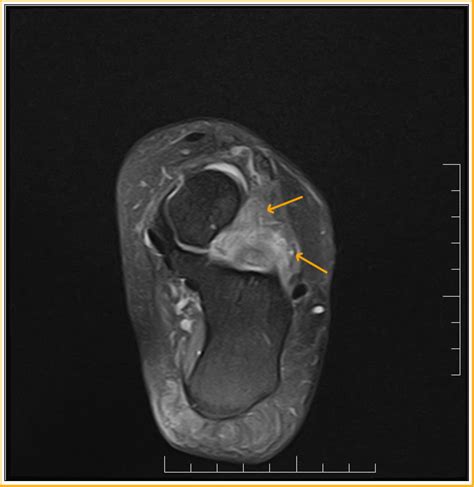 Sinus Tarsi Syndrome : MRI - Sumer's Radiology Blog