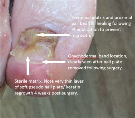 Damaged Nail Matrix Treatment