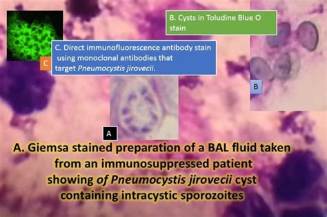 Pneumocystis pneumonia: Introduction, symptoms, lab diagnosis