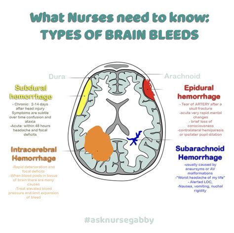 Types Of Brain Hemorrhages Subdural Hematoma Hemorrhage Nursing | Porn Sex Picture
