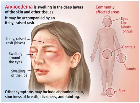 Angioedema | Allergy and Clinical Immunology | JAMA | JAMA Network