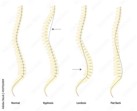 Spine deformity types and normal spine comparison. Lateral view of spine with deformity Stock ...