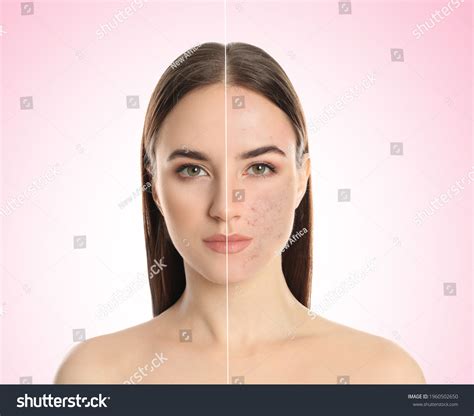 3,979 Acne before and after Images, Stock Photos & Vectors | Shutterstock