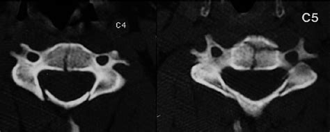 Case 1. CT scans demonstrating the C4 sagittal body fracture with ...