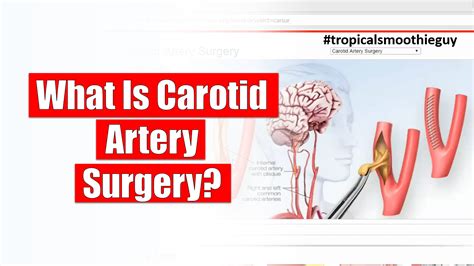 What Is Carotid Artery Surgery?