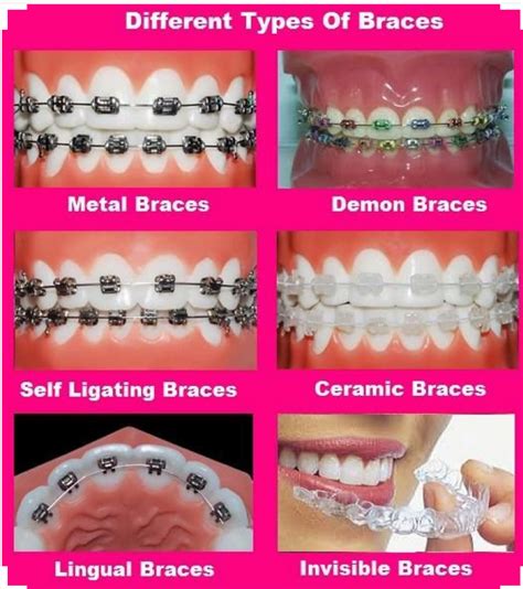 Considering braces? A few of the options available to you. | Dental ...