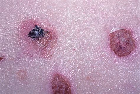 Pemphigus Vulgaris Symptoms Pictures – 34 Photos & Images / illnessee.com