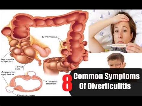 8 Common Symptoms Of Diverticulitis - YouTube