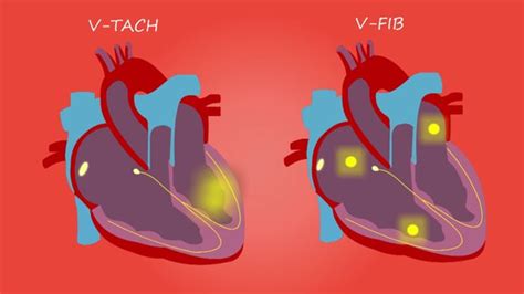 Heart, Treatment, Medical. Free Stock Video - Pixabay