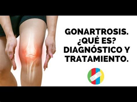 GONARTROSIS. ¿Qué es?, Diagnóstico y Tratamiento. - YouTube