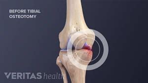 Knee Osteotomy Risks and Complications | Arthritis-health