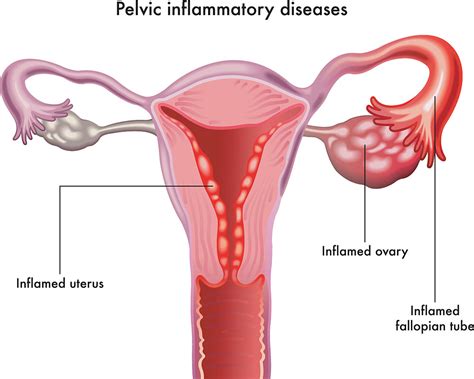 Pelvic Inflammatory Disease Graph