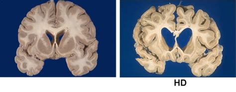 Huntington’s Disease – Gray laboratory