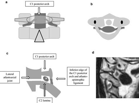 Neural Foramen Mri