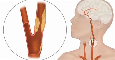 New, Less Invasive Surgery To Clear Blocked Arteries - CBS Minnesota