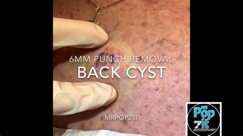 Drainage and punch removal of cyst. Cyst pop. Big squeeze. Punch ...