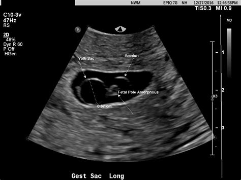 Diagnostic Ultrasound in the First Trimester of Pregnancy | GLOWM