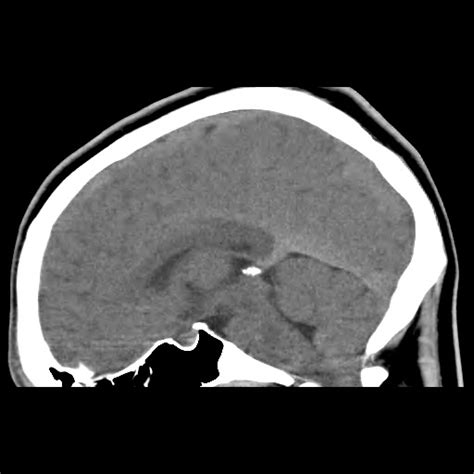 Radiology Cases: AC I and Cervical Syrinx