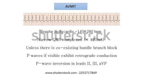 Ecg Feature Avnrt Criteria Svt Stock Illustration 2253717869 | Shutterstock