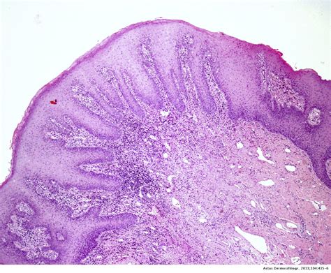 Median Rhomboid Glossitis Histology