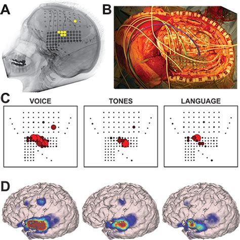 Recording Human Electrocorticographic ECoG Signals for Neuroscientific Research and Real-time ...