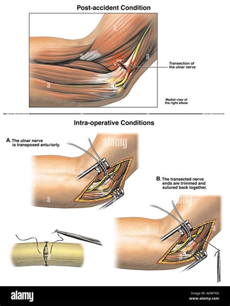 Ulnar nerve surgery hi-res stock photography and images - Alamy