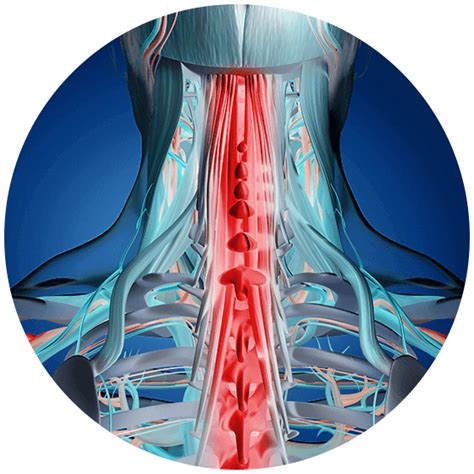 Symptoms Of Torn Neck Muscle