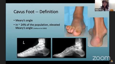 CavoVarus Feet Reconstruction — OrthopaedicPrinciples.com