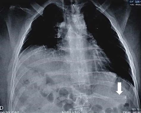 Chest X-ray showing a ventriculoperitoneal (VP) shunt catheter in the ...