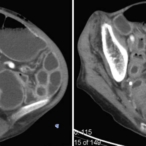 Videocapsule enteroscopy images showing grossly oedematous jejunum with ...