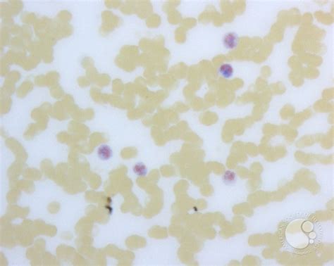 Leukocyte Alkaline Phosphatase Scoring - 2.